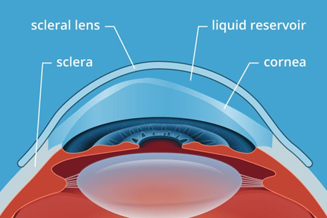 Scleral Lenses