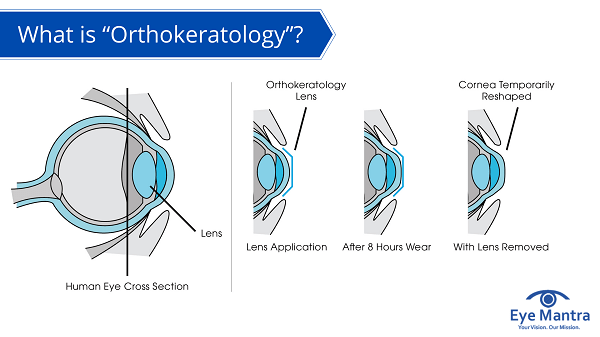 orthokeratology hyperopia