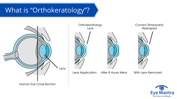 orthokeratology