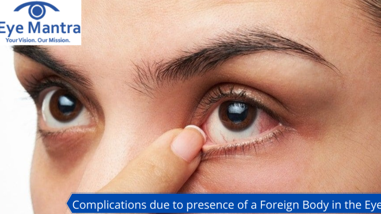 Foreign body sensation in the eye - Miranza