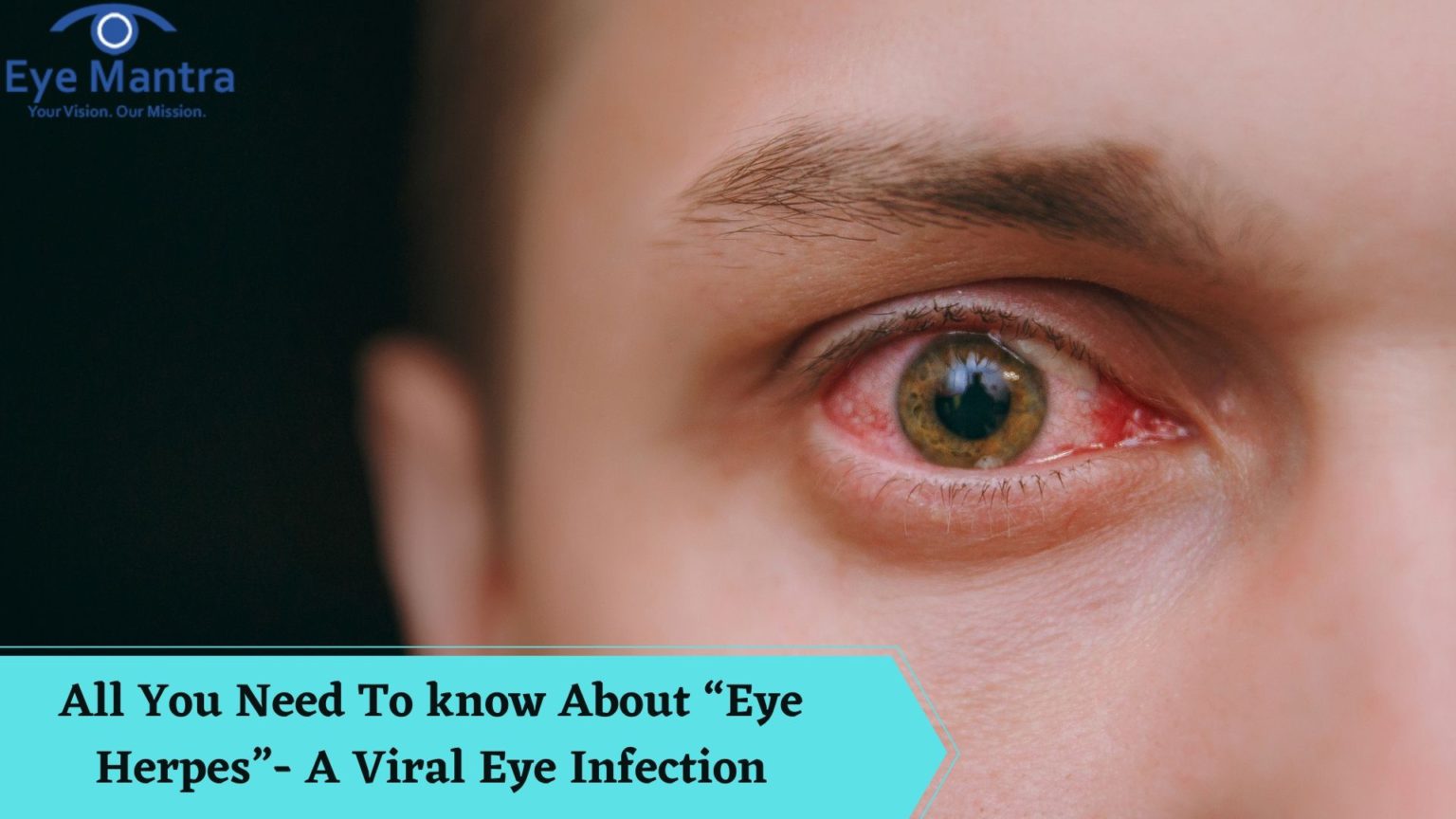 All You Need To know About Eye Herpes- A Viral Eye Infection