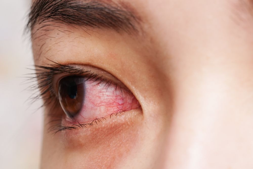 Symptoms of a foreign body in the eye