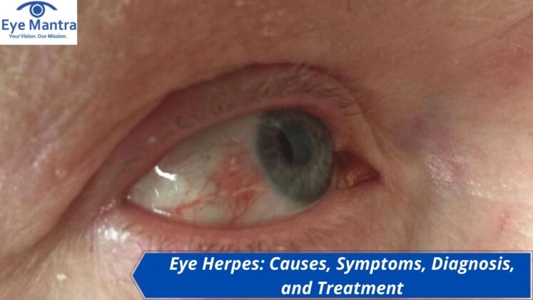 Eye Herpes Causes Symptoms Diagnosis And Treatment