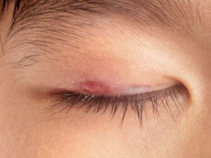 Diagnosis of Ingrown Eyelashes