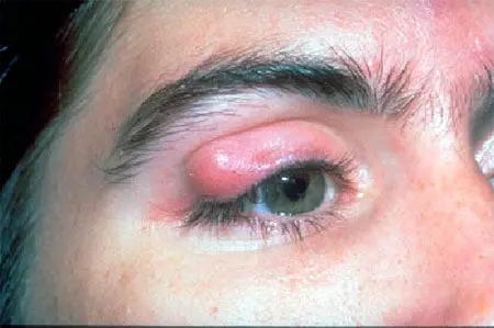 Eye Chalazion