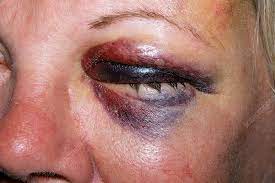 Serious effects of black eye