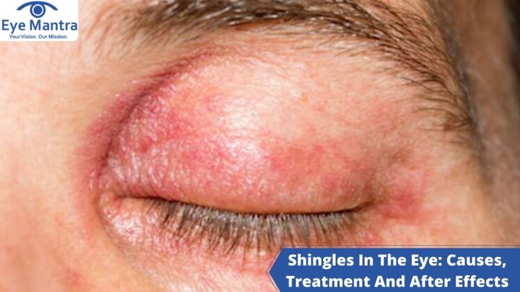 Shingles In The Eye Causes Treatment And After Effects