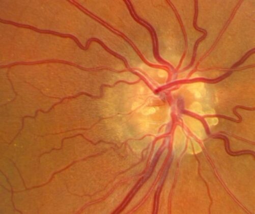 optic disc drusen