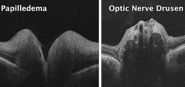 optic nerve drusen vs. papilledema