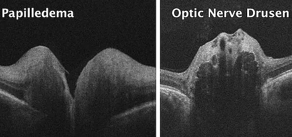 optic nerve drusen vs. papilledema