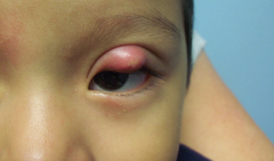 Eye Chalazion | Causes, Treatment And Diagnosis | Stye vs Chalazion