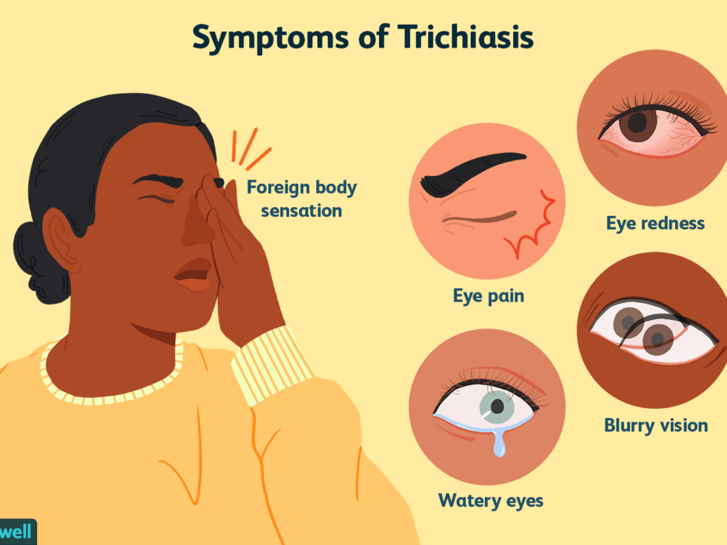 Ingrown Eyelashes (Trichiasis): Causes, Symptoms & Treatment