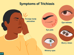 symptoms of trichiosis