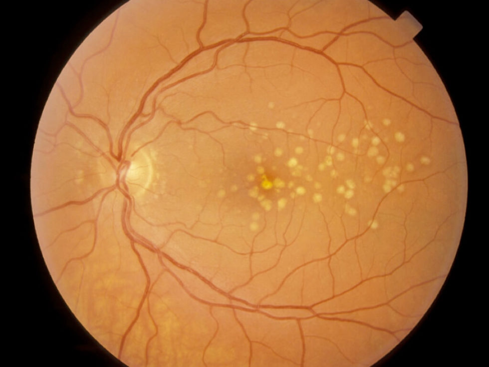 What Are Drusen And Yellow Eye: Causes And Diagnosis