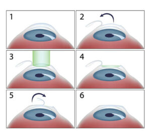 lasik-surgery-procedure