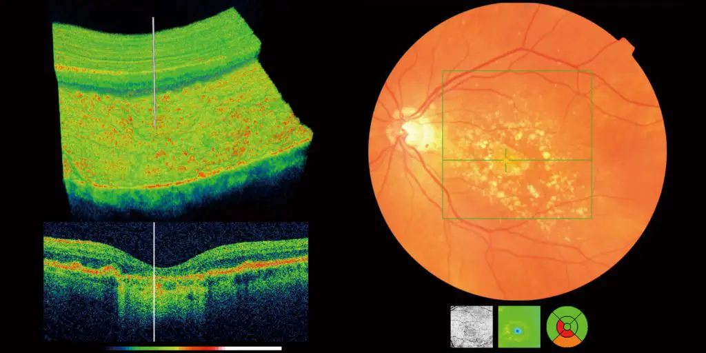 Obraz z optycznej tomografii koherentnej