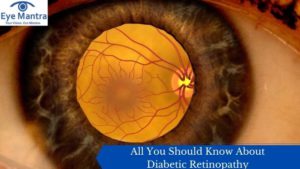 All You Should Know About Diabetic Retinopathy