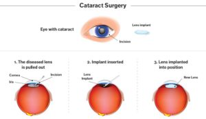 process of cataract surgery