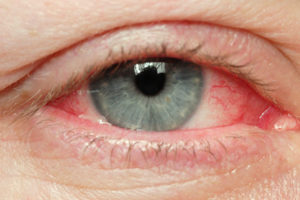 eye antibiotics