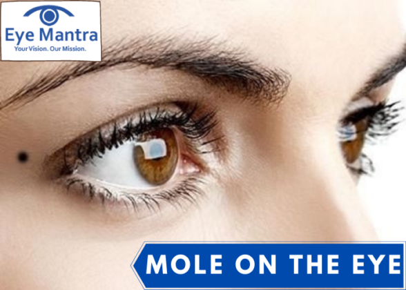 mole on the eye