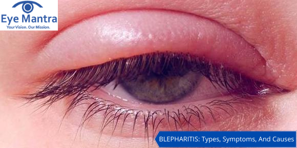 BLEPHARITIS_ Types, Symptoms, And Causes