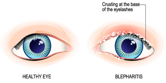 Blepharitis Causes Symptoms Complications And Treatment 