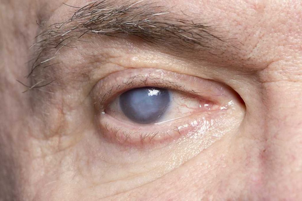 Cataracts eye diseases