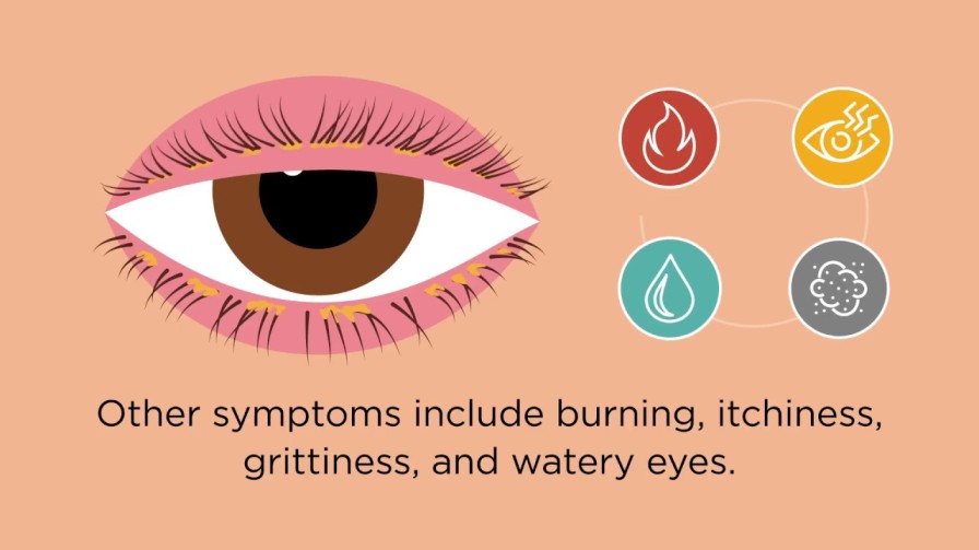 symptoms of blepharitis