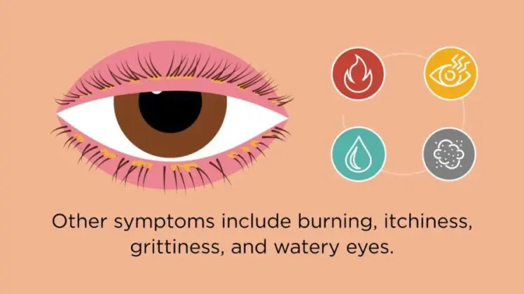 symptoms of blepharitis