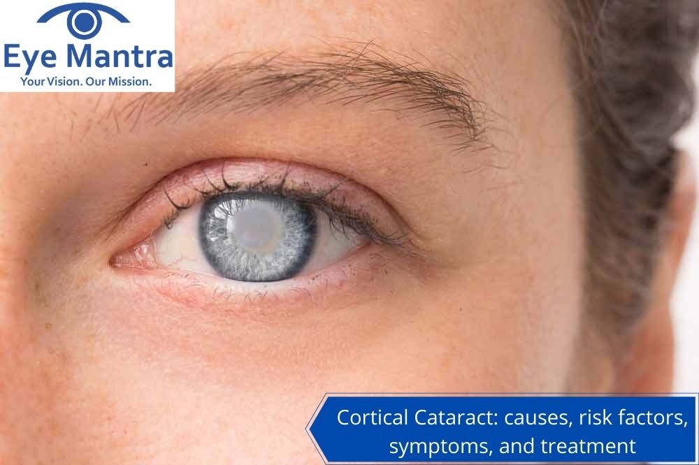Cortical Cataract causes, risk factors, symptoms, and treatment