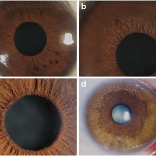 Diagnosis of Fuchs’ corneal dystrophy