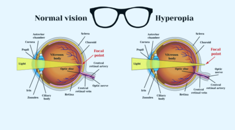 hyperopia farsightedness eyemantra causes