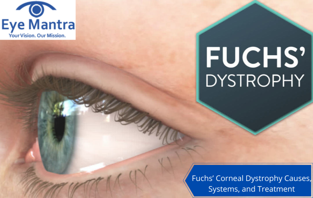 Fuchs’ Corneal Dystrophy Causes, Systems, and Treatment
