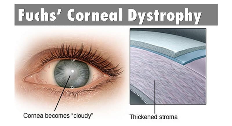 Fuchs’ corneal dystrophy