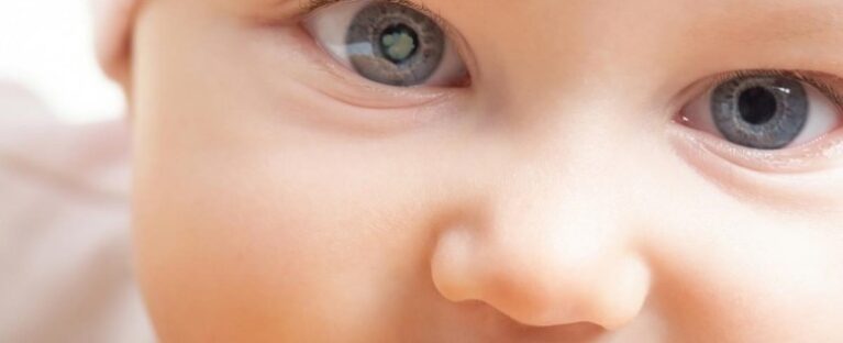 Pediatric Cataracts