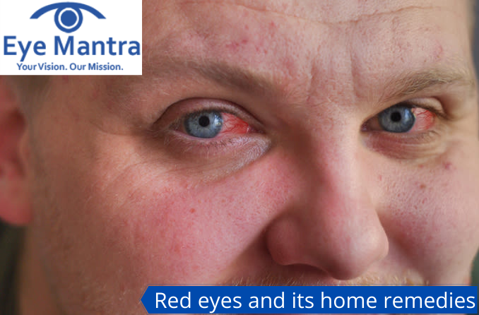 Red eyes-its home remedies