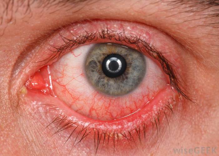 Side Effects of Antibiotic eyedrops
