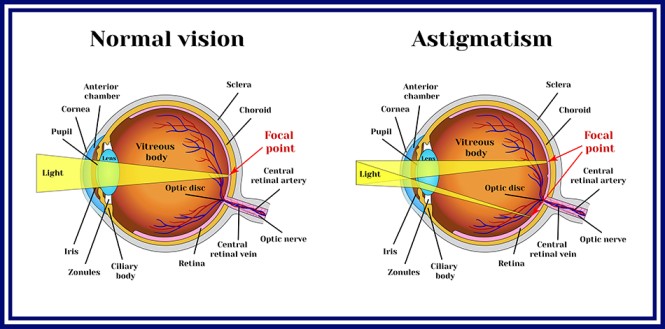 Treatment for astigmatism