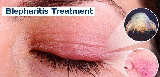 Treatment of Blepharitis