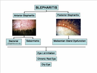Types of Blepharitis
