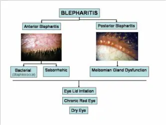 Types of Blepharitis