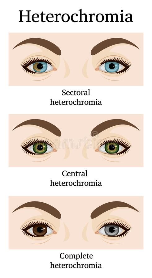 Types of heterochromia