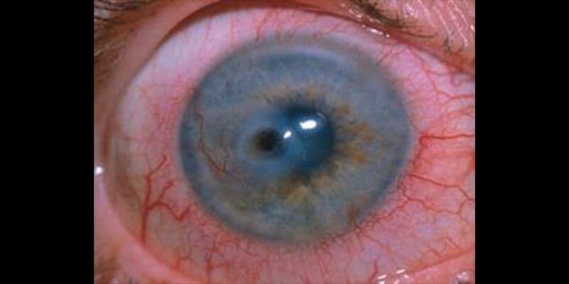 corneal disorder