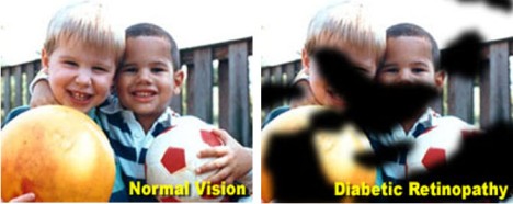 disease causing peripheral vision
