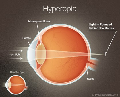 hyperopia