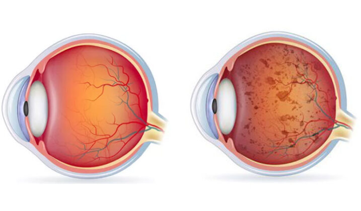 retinitis pigmentosa