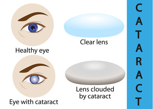 cataracts