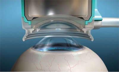 Advantages of Femtosecond Laser-Assisted Cataract Surgery (FLACS)