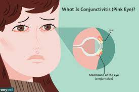 Allergic conjunctivitis