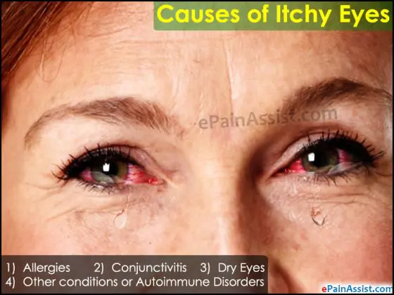 causes of itchy eyes